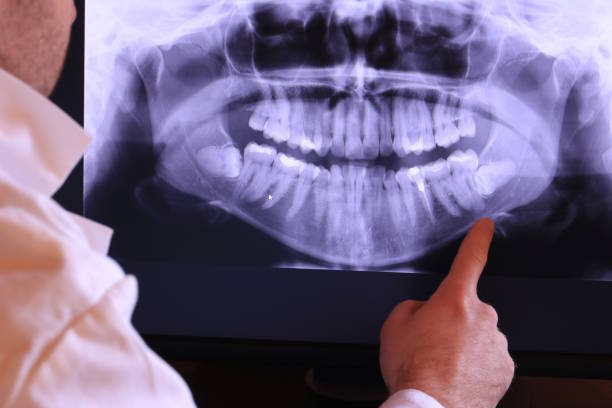 Best Emergency Wisdom Teeth Removal in Fort Mill, SC