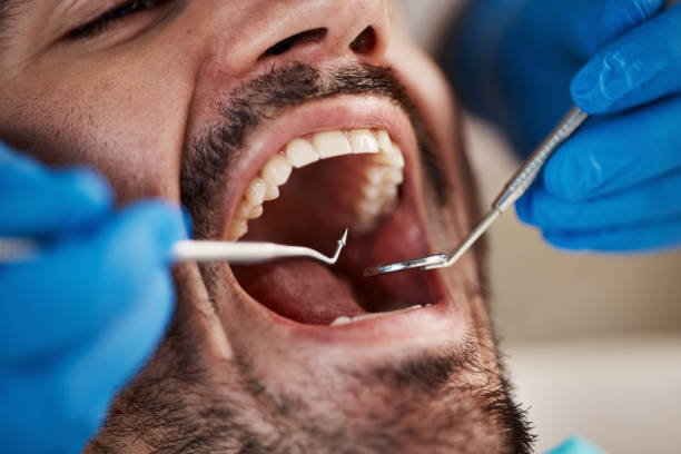 Best Emergency Broken Tooth Repair in Fort Mill, SC